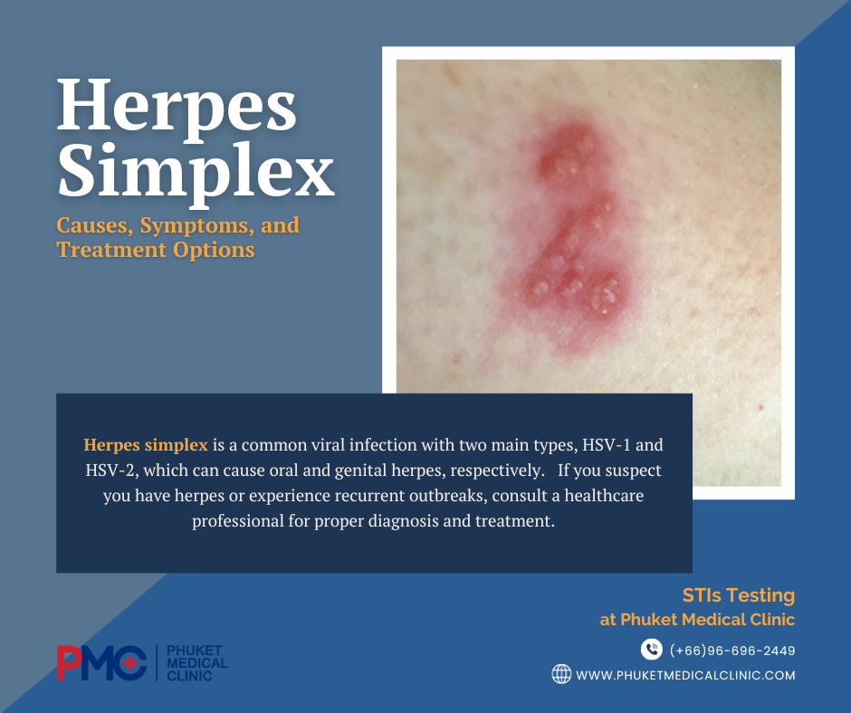 Herpes Simplex Causes, Symptoms, and Treatment Options