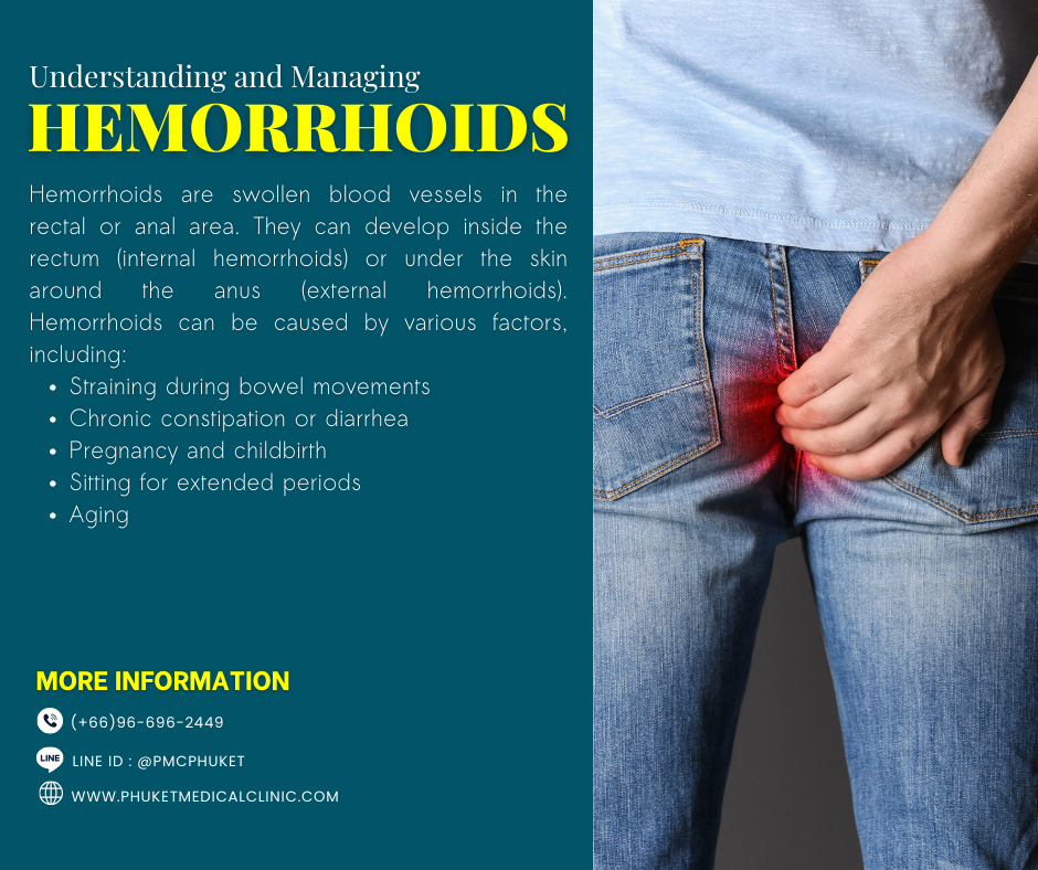 Understanding and Managing Hemorrhoids