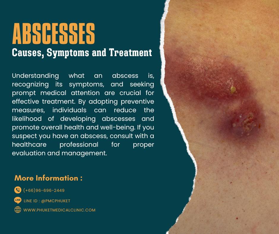 Abscesses-Causes-Symptoms-and-Treatment
