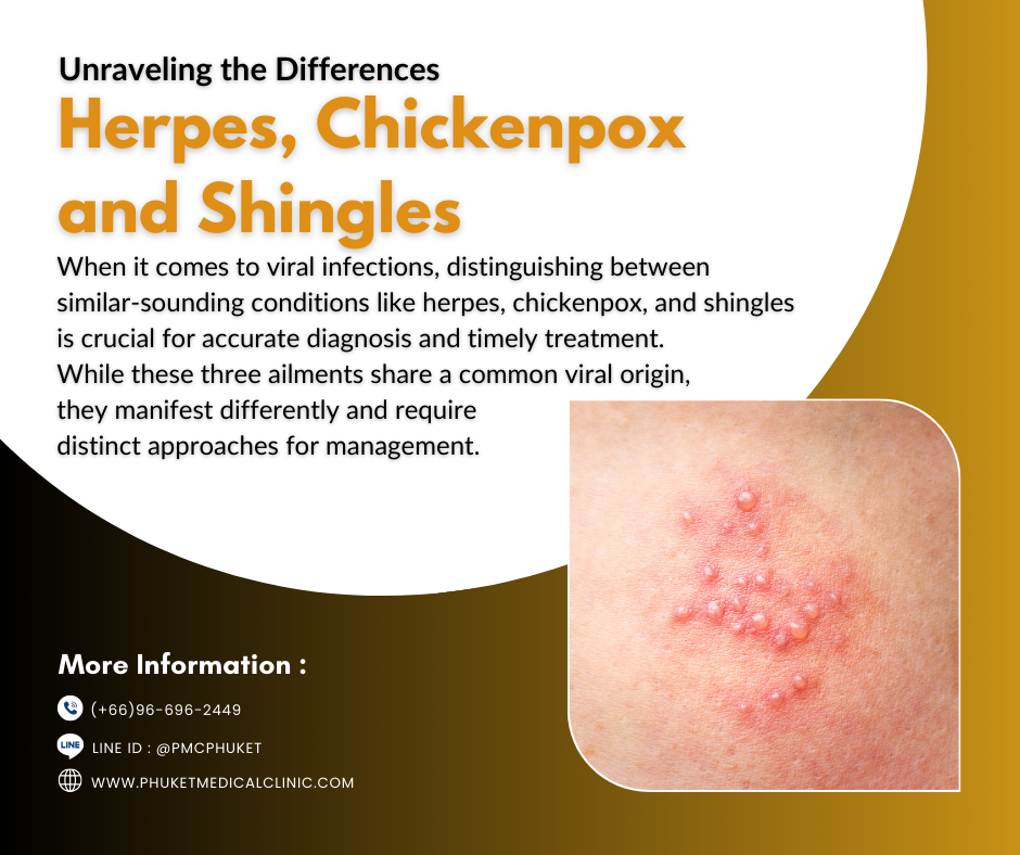 Unraveling the Differences Herpes, Chickenpox and Shingles