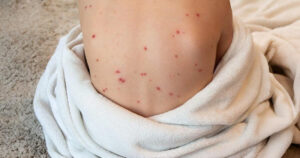 measles vs german measles