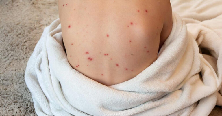 measles vs german measles